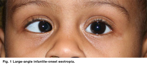 Esotropia Strabismus Eye Disorder