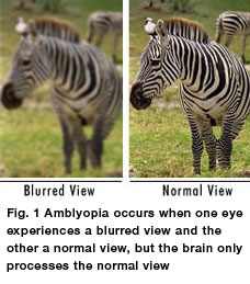 Amblyopia / Lazy Eye Diagnosis