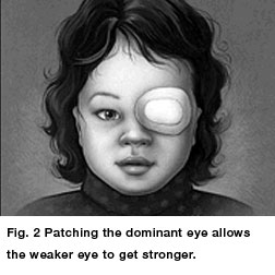 Amblyopia Eye Patching Treatment