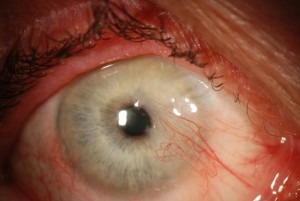 800px-Pterygium