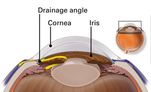 Narrow / Drainage Angle Glaucoma Surgery