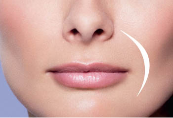 JUVÉDERM Wrinkle Treatment