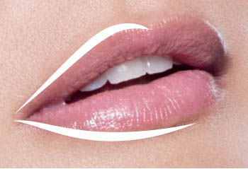 Juvederm Lip Filler