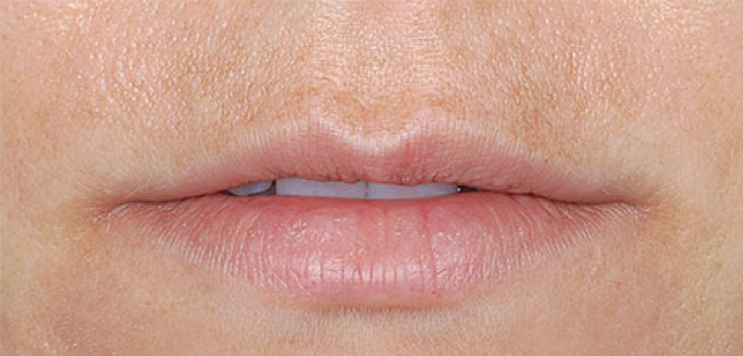 Thin Lip Treatment