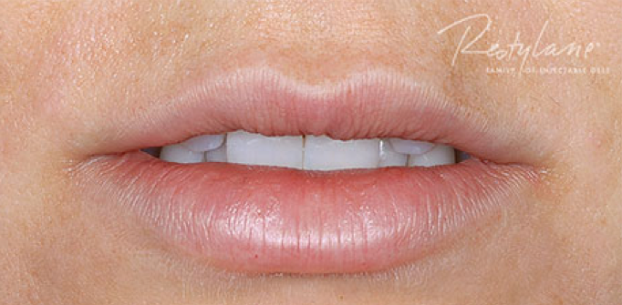 Lip Augmentation